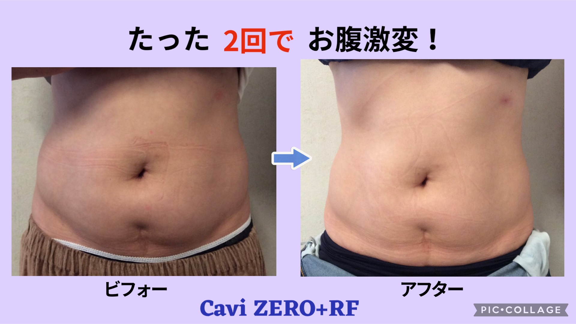 最新の痩身マシン✨新型CaviZERO＋RF✨只今お得なキャンペーン実施中 