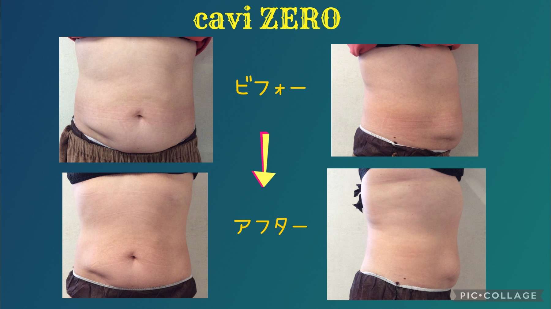 短時間で圧倒的な効果！！痩身マシーン☆caviZERO（キャビゼロ